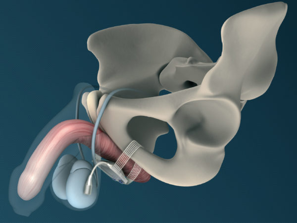 ATOMS Adjustable Implant SUI