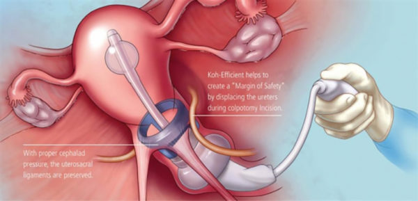 Cooper Surgical Advincula Delineator Uterine Manipulation