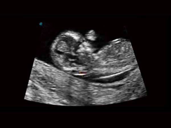 P11 Elite Premium Colour Doppler System - Image 2