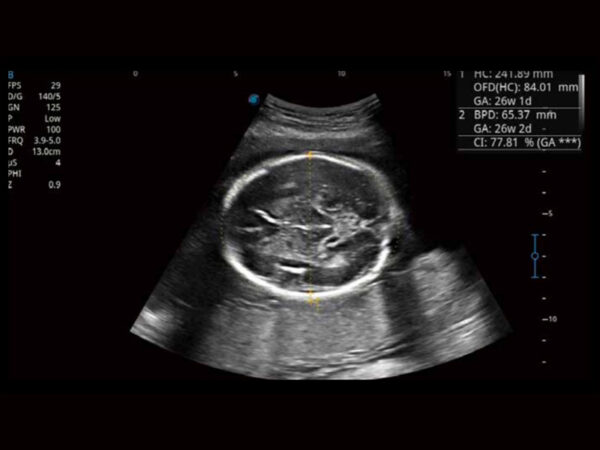 P11 Elite Premium Colour Doppler System - Image 3