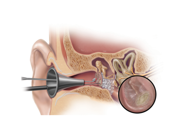 Biodesign Otologic Repair Graft