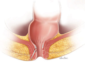 Biodesign Anal Fistula Plug