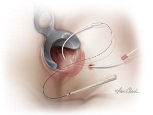 Biodesign Anal Fistula Plug