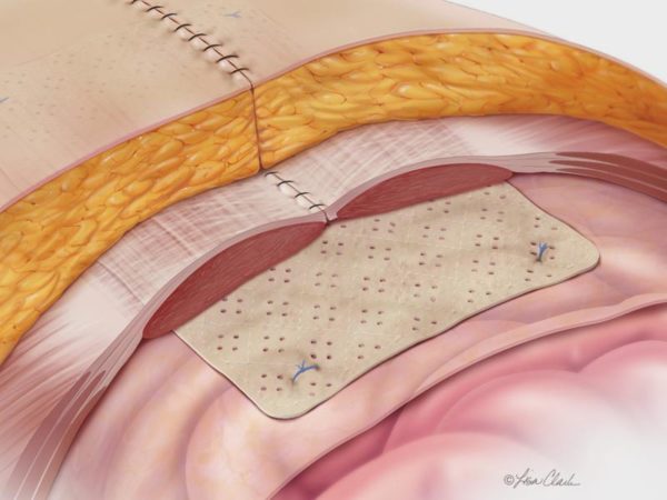 Biodesign Hernia Graft