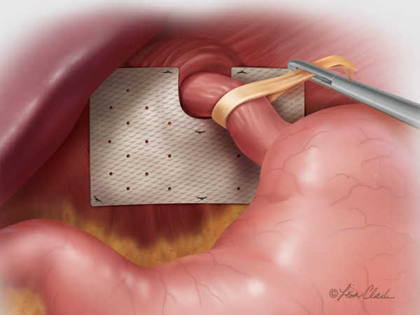 Biodesign Hiatal Hernia Graft