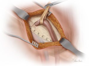 Biodesign Inguinal Hernia Graft