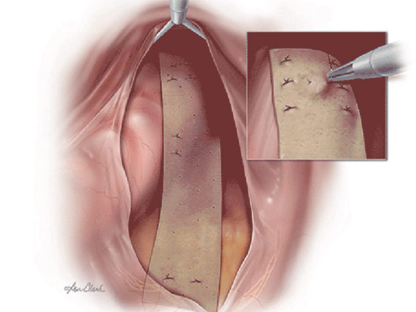 Biodesign Rectopexy Graft