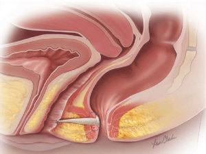 Biodesign Rectovaginal Fistula Plug_In-Situ