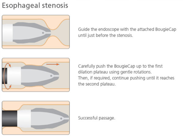 Ovesco BougieCap Bougienage - Image 3