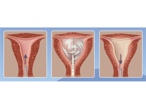 Cavaterm Endometrial Ablation_Insitu