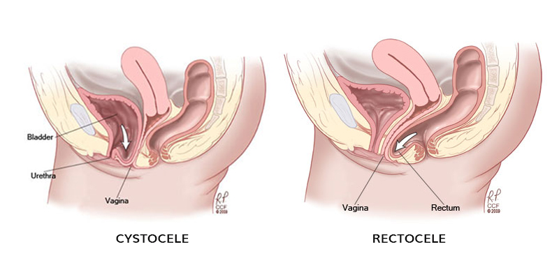 Pessary incarcerated in the bladder: A case presentation of vaginal pessary  morcellation