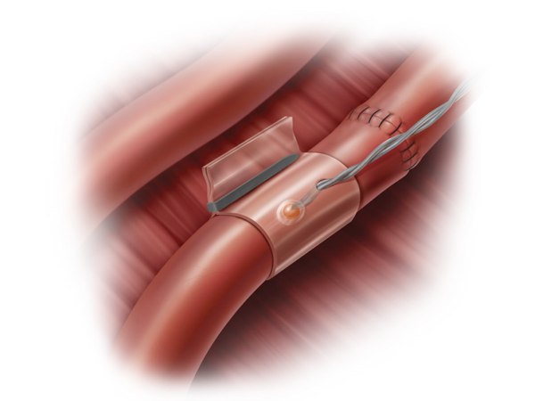 Doppler Blood Flow Management