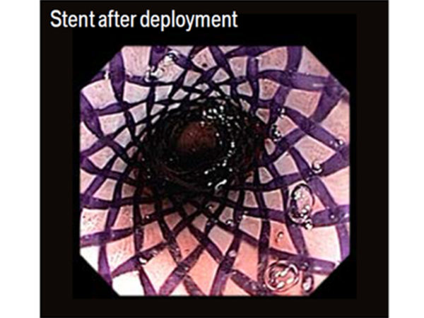 ELLA Oesophageal Stents_Biodegradable