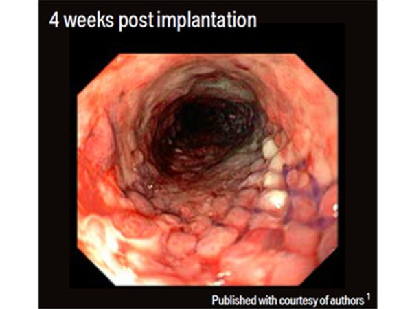 ELLA Oesophageal Stents_Biodegradable