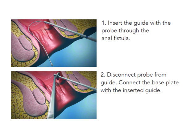 FiXcision Anal Fistulas