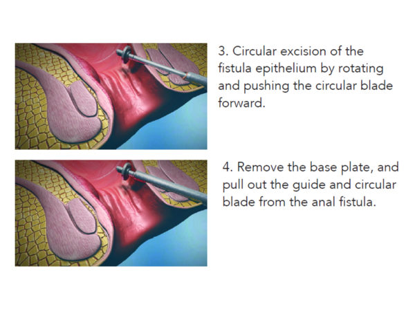 FiXcision Anal Fistulas