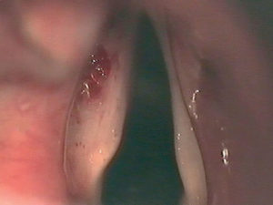 Laborie VOX Vocal Cord Implants