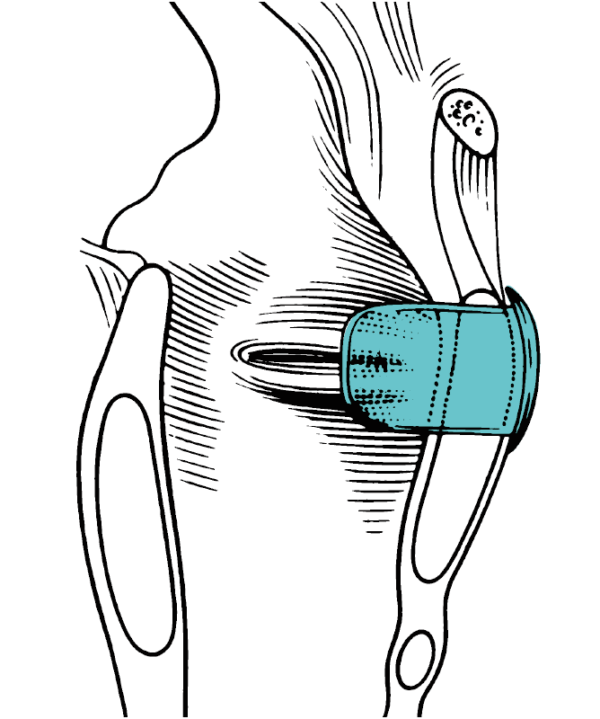 MONTGOMERY® LARYNGEAL KEEL - Image 2