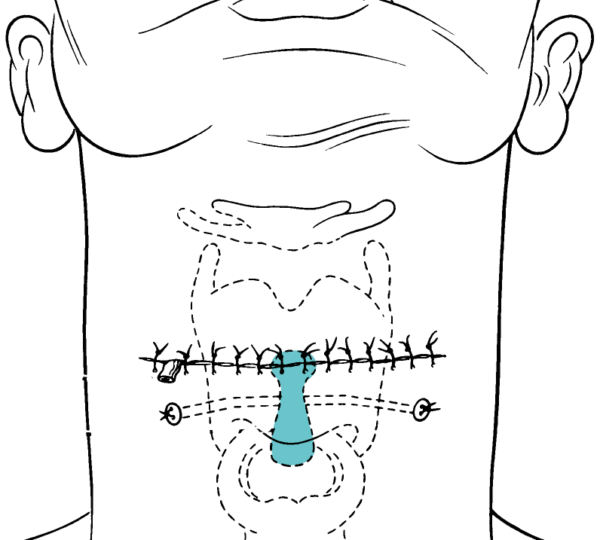MONTGOMERY® LARYNGEAL STENT - Image 2
