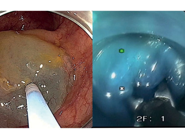 LiftUp® Thermoreversible Injection Agent - Image 3