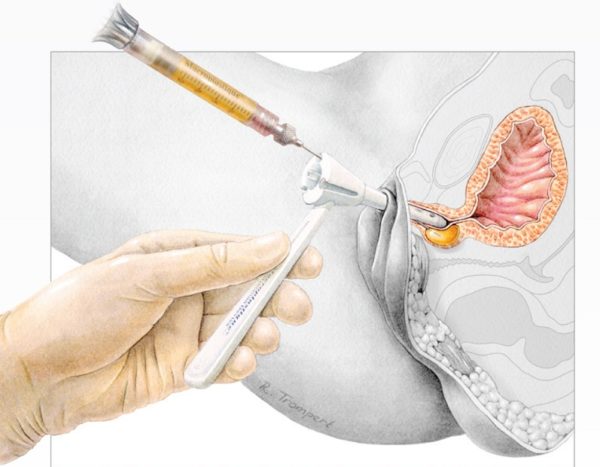 Macroplastique SUI Implant