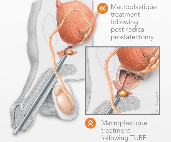 Macroplastique SUI Implant