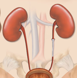 Memokath 051 Ureteric Stents