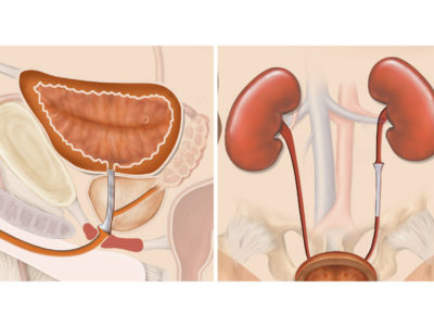 Memokath Urinary Stent