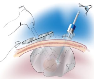 MoreCellSafe Containment System Power Morcellation Insitu