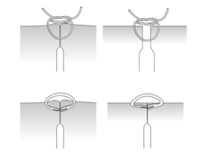 OTSC vs Suture