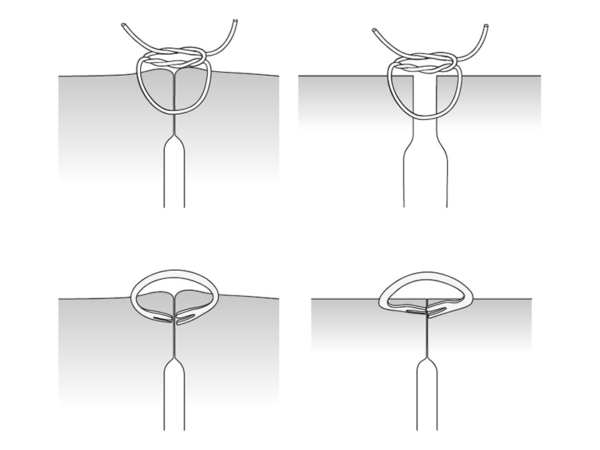 OTSC vs Suture