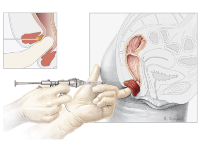 PTQ Faecal Incontinence Implant