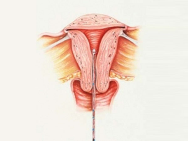 Pipelle Endometrial Sampling