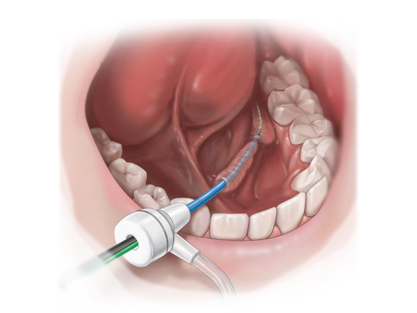 Sialendoscopy Solutions