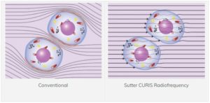 Sutter Curis Radiofrequency Energy Distribution
