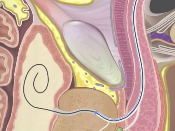 Urethral Catheterisation Device (UCD) - Image 3