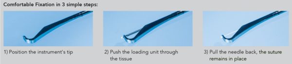iStitch Sacrospinous Fixation Steps